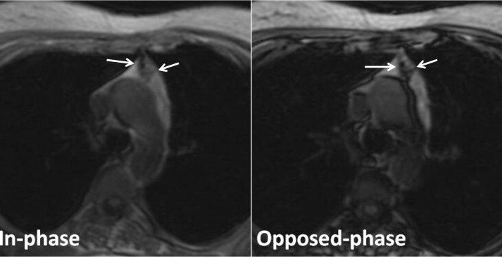 Thymic hyperplasia in a 40-year-old woman with myasthenia gravis.