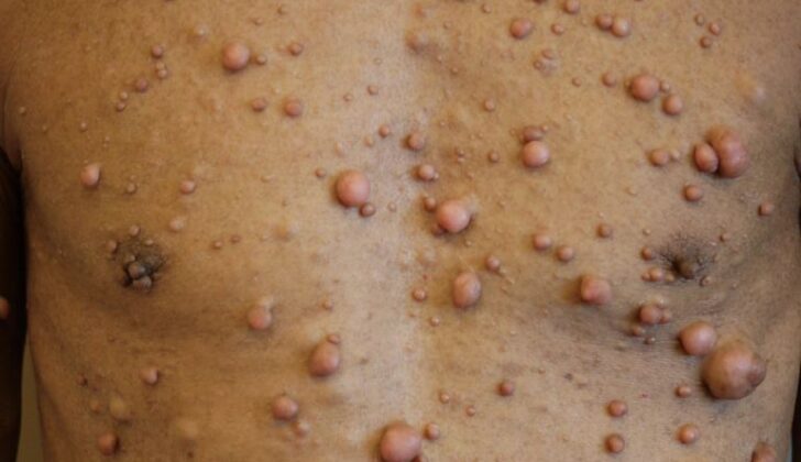 Neurofibromatosis, NF1, NF2, and Schwannomatosis. Neurofibromatosis encompasses three distinct disorders: neurofibromatosis type 1 (NF1), neurofibromatosis type 2 (NF2), and schwannomatosis. 