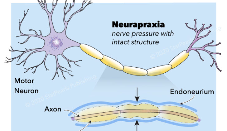 Neurapraxia, motor neuron, axon, myelin, endoneurium