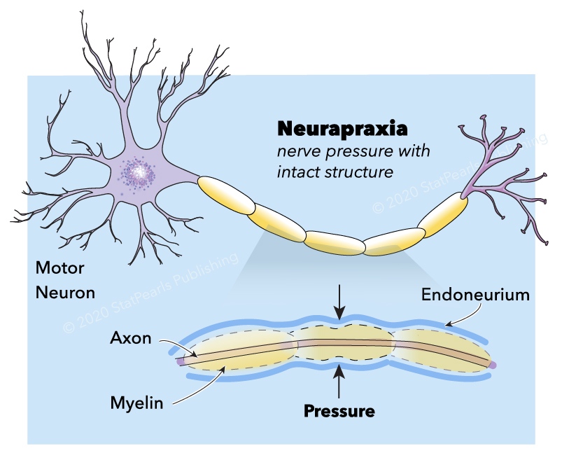 Neuropraxia: qué es, causas, síntomas y tratamiento | Guía de salud ...