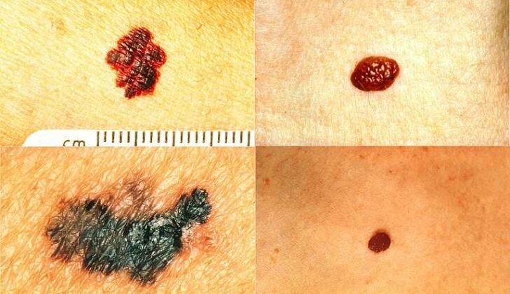 Part of the ABCDs for Detection of Melanoma. On the left side from top to bottom: melanomas showing (A) asymmetry, (B) a border that is uneven, ragged, or notched, (C) coloring of different shades of brown, black, or tan and (D) diameter that had changed in size. The normal moles on the right side do not have abnormal characteristics (no asymmetry, even border, even color, no change in diameter).