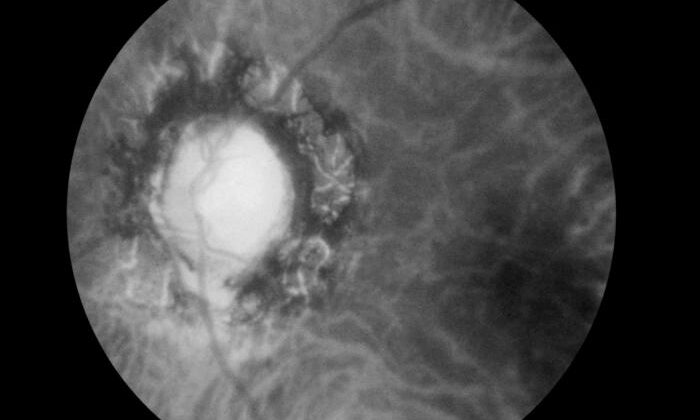 Fundoscopic Image of Late Neuroocular Syphilis. This is a fundoscopic image of the effect of late neuroocular syphilis on the optic disk and retina, including pathology, severe optic-nerve atrophy, chorioretinitis, and inflammation of the choroidal and neural layers of the retina.
