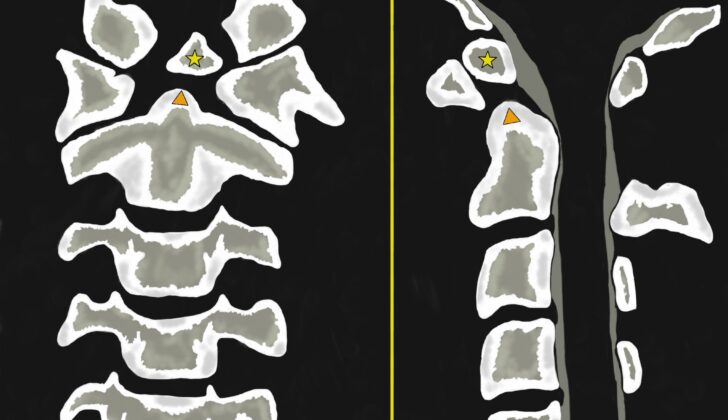 Os Odontoideum. Anterior-posterior (left-sided image) and lateral (Right-sided image) views. They show an oval or round-shaped ossicle with smooth circumferential cortical margins (yellow star) representing a hypoplastic odontoid process (Orange triangle) that has no continuity with the C2 vertebral body. It is often attached to the anterior arch of C1 through an intact transverse ligament.