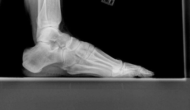 Lateral Ankle Radiograph, Os Peroneum