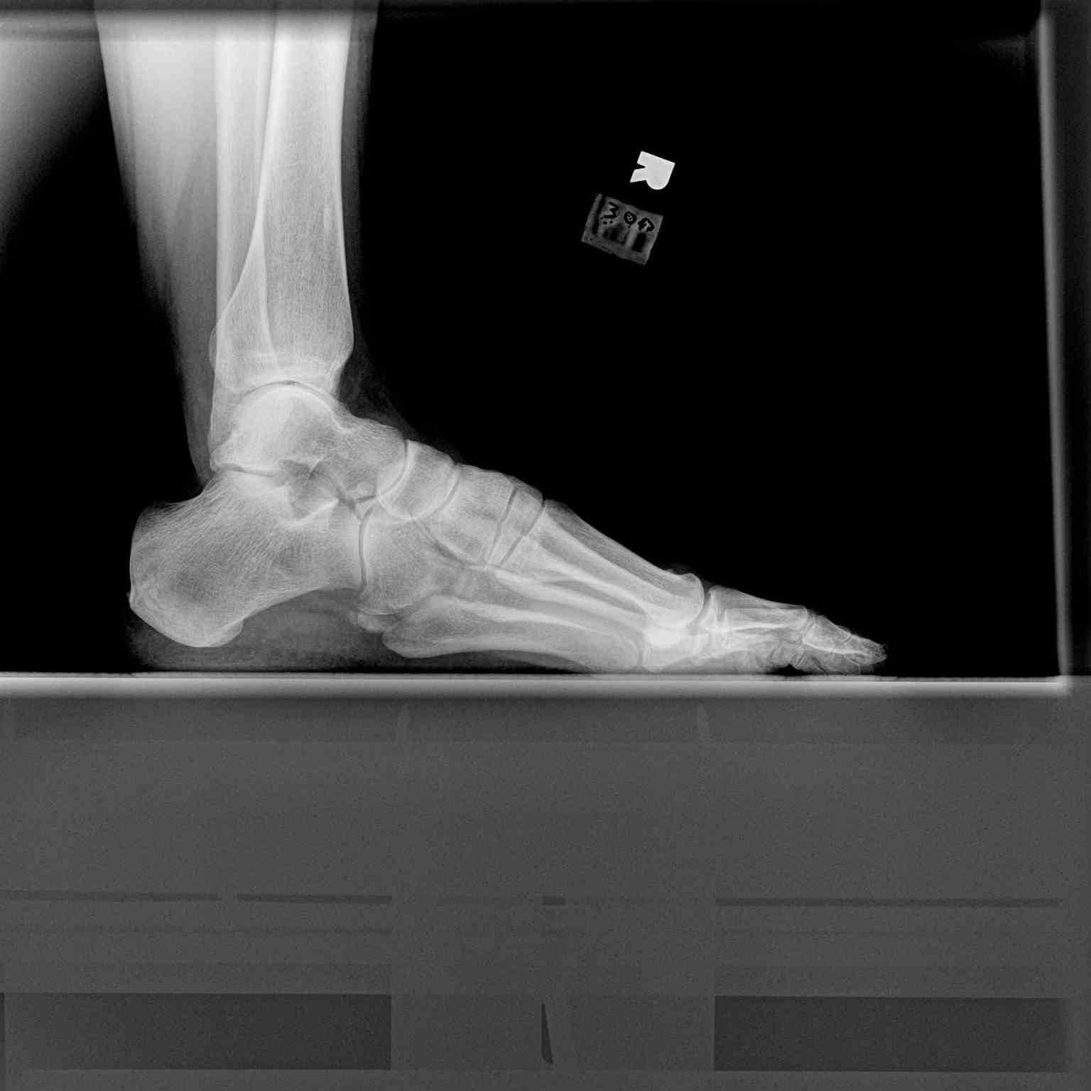 Lateral Ankle Radiograph, Os Peroneum