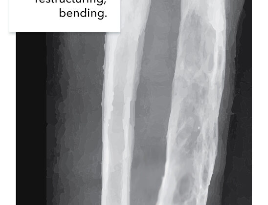 Paget Disease of the long bone