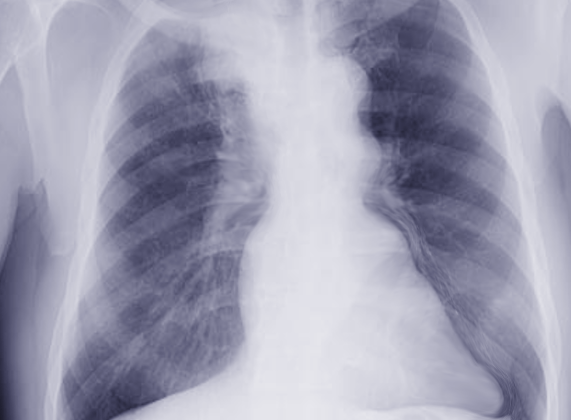 Pancoast Tumor