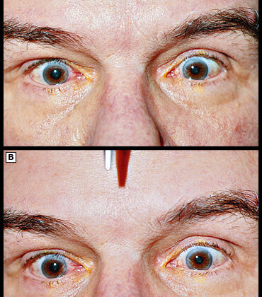Parinaud Syndrome is a rare neurological disorder characterized by impaired upward gaze, difficulty with eye movements, and other visual disturbances.