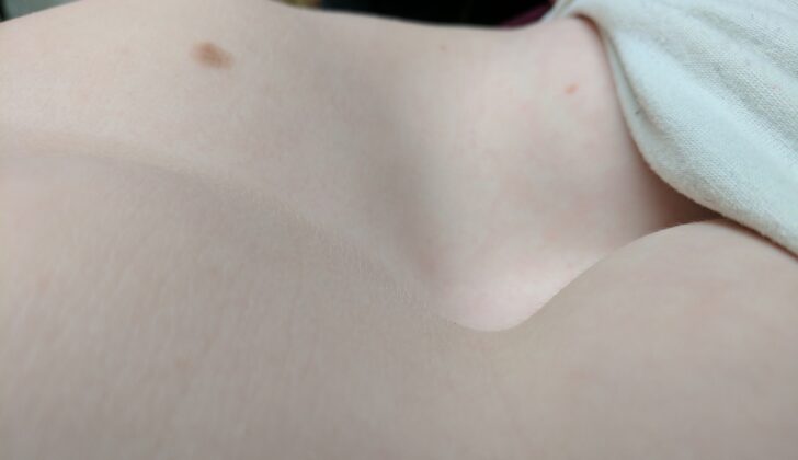Pectus excavatum in a 12 yr old female