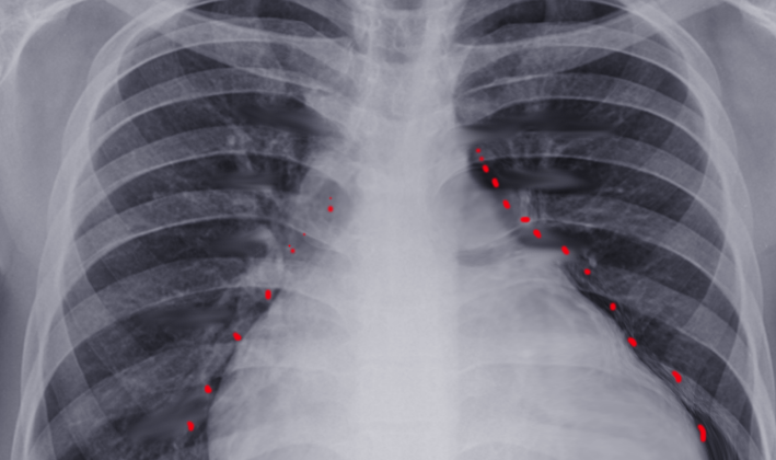 Uremic effusion