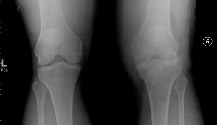 Frontal view of the knees in this patient with right sided knee pain and swelling. There are erosions with high diffuse soft tissue swelling in the right knee and associated arthritic changes due to pigmented villonodular synovitis (PVNS).