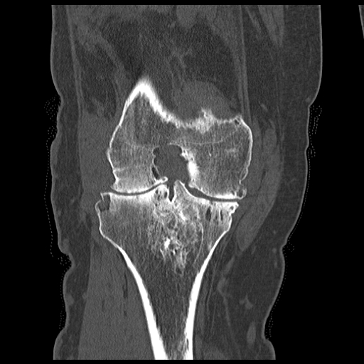 Coronal CT image in a patient with knee swelling demonstrating erosions and a
joint effusion due to pgimented villonodular synovitis (PVNS).