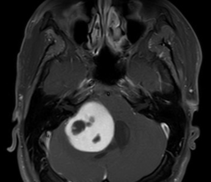 MRI of the Brain Showing Pilocytic Astrocytoma.