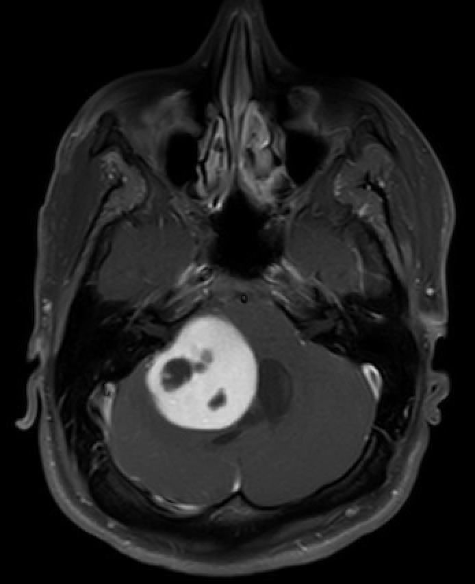 MRI of the Brain Showing Pilocytic Astrocytoma.