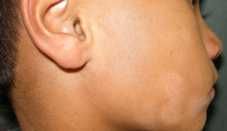 Pityriasis Alba. Pityriasis alba is a prevalent and benign dermatological condition characterized by lesions that usually appear on the face, especially the cheeks, arms, and upper trunk of adolescents and children.