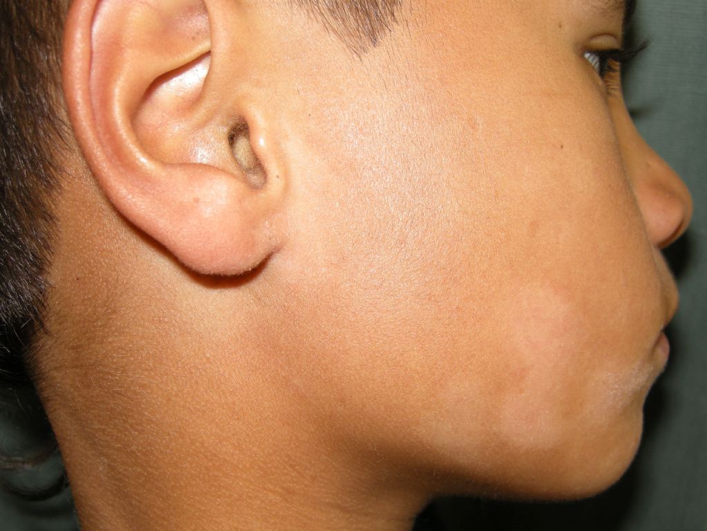 Pityriasis Alba. Pityriasis alba is a prevalent and benign dermatological condition characterized by lesions that usually appear on the face, especially the cheeks, arms, and upper trunk of adolescents and children.