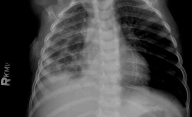 Chest Radiograph, Pneumatoceles Pneumonia