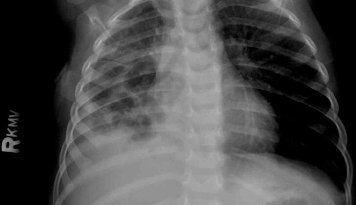 Chest Radiograph, Pneumatoceles Pneumonia