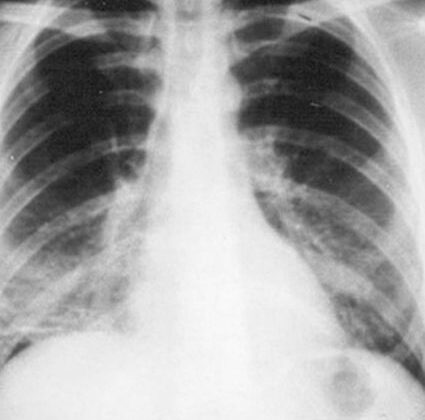 Pneumocystis Carinii Pneumonia. This patient's lung x-ray shows infection with Pneumocystis Carinii pneumonia.