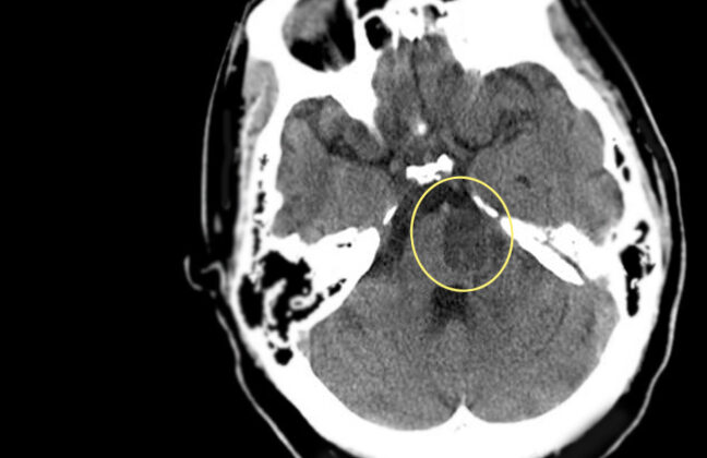 Pontine infarction