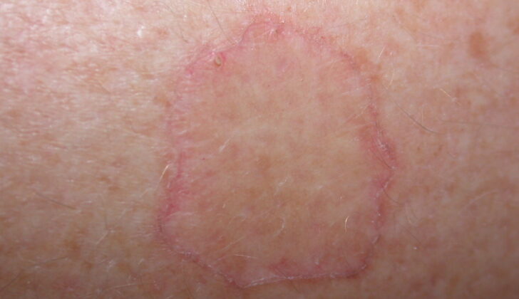 Porokeratosis