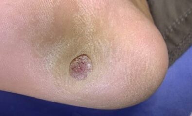 Poroma on a Patient's Sole. The image shows a poroma on the sole of a patient's foot.