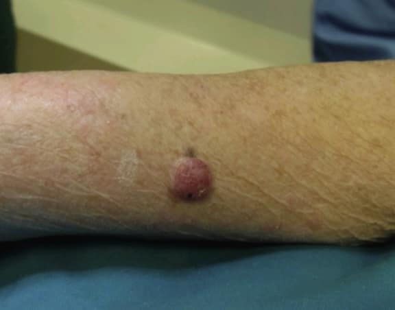 Nodular Lesion of Poroma. The image shows a red, nodular lesion characteristic
of a poroma in a patient.