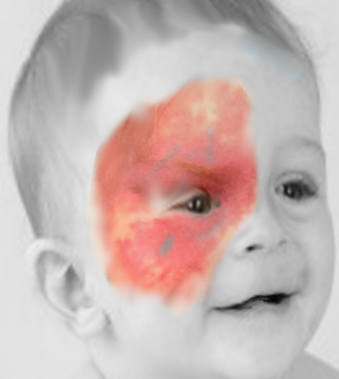 Port Wine Stain (SWS)