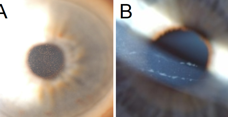 A: Central guttae are noted centrally in this patient with Fuchs Endothelial Corneal Dystrophy. B: Classic band-like structures in the cornea in patients with Posterior Polymorphous Corneal Dystrophy.