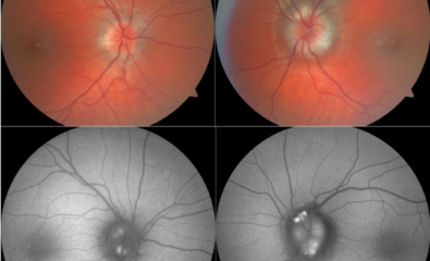 Colour fundus photos of optic nerves with visible optic disc drusen (top). Fundus autofluorescence photos of the same nerves highlights the superficial optic disc drusen which autofluoresce (bottom).