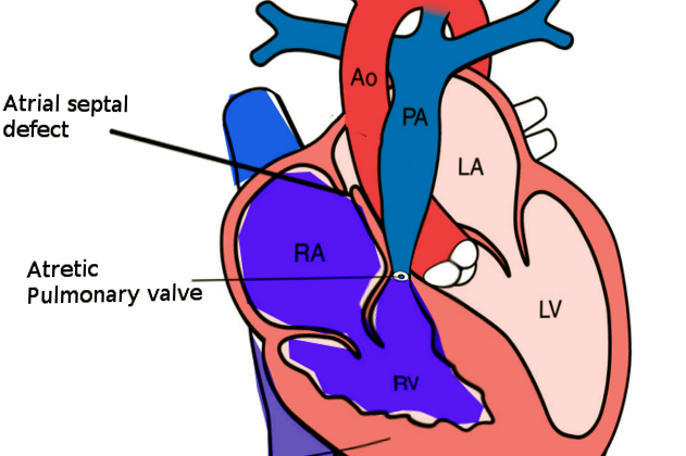 Pulmonary Atresia With Intact Ventricular Septum. RA, right atrium; RV, right ventricle; LA, left atrium; LV, left ventricle; Ao, aorta.