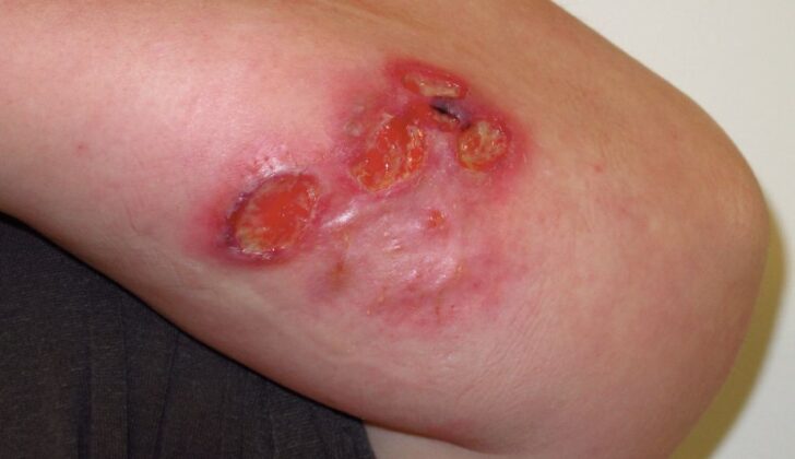 Pyoderma Gagngrenosum