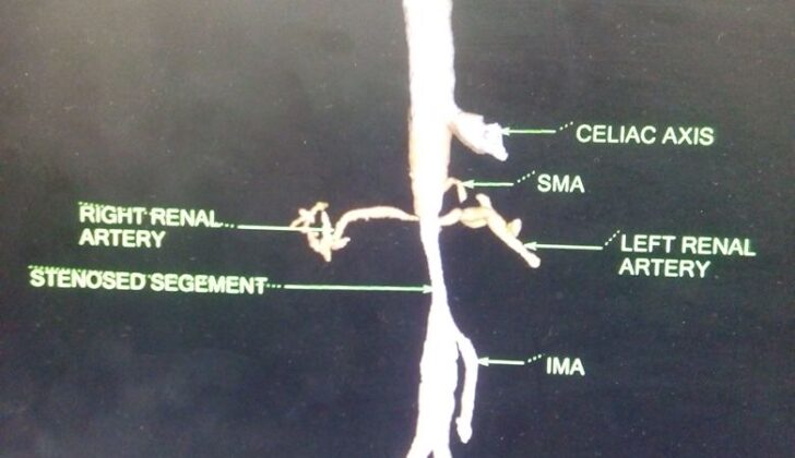 Takayasu Arteritis, Renal Artery Stenosis Bilaterally