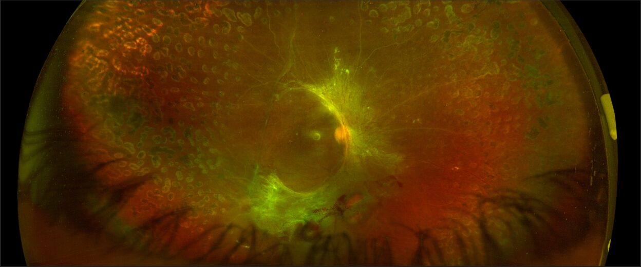 Photopsia Visual Example Photopsia Archives - MD Searchlight