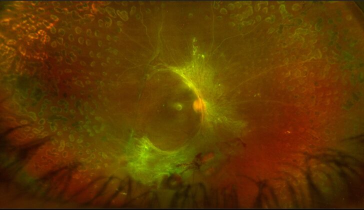 Proliferative Diabetic Retinopathy. Tractional retinal detachment.