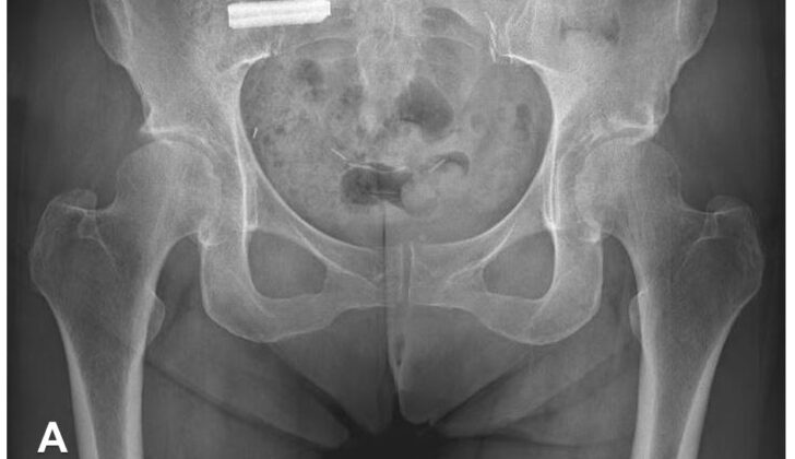 Anteroposterior Radiograph, Sacroiliitis, Right Sacroiliac Joint Fusion