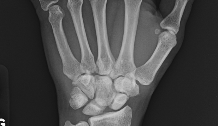 Scapholunate Advanced Collapse X-ray. Scapholunate interval widening and proximal migration of the capitate. Findings are consistent with early scapholunate advanced collapse.