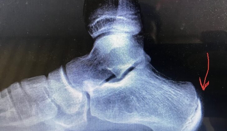 Severs Disease- calcaneal apophysitis in an adolescent