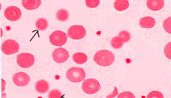 Hereditary spherocytosis is a genetic disorder characterized by abnormal red blood cells that are spherical in shape, leading to anemia and other complications.