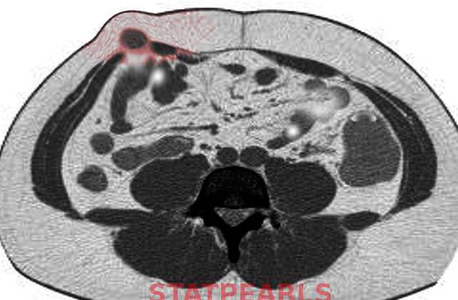 Spigelian hernia