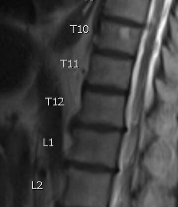 T10 Hemangioma