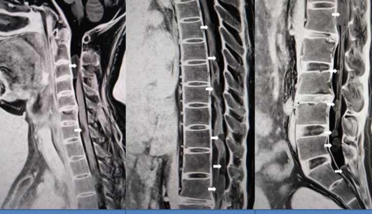 Holospinal drop metastasis