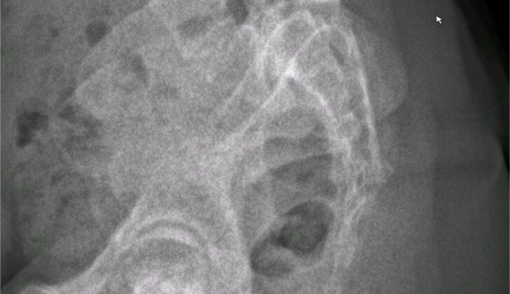 Lateral X-ray of the pelvis and lower lumbar spine showing spondylolysis and spondylolisthesis.