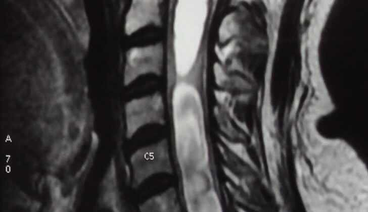 Syringomyelia Visualized on MRI in a Patient With Hindbrain Herniation.