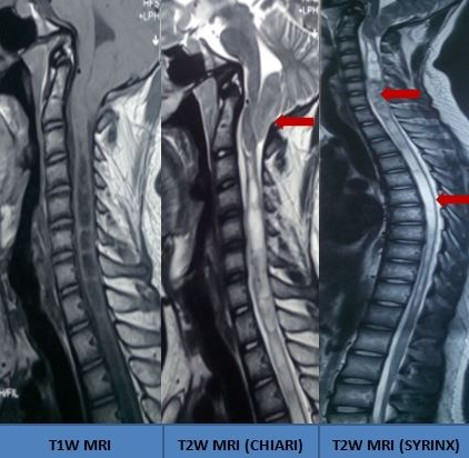Holocord Syrinx Visualized on MRI in a Patient With Chiari Malformation.