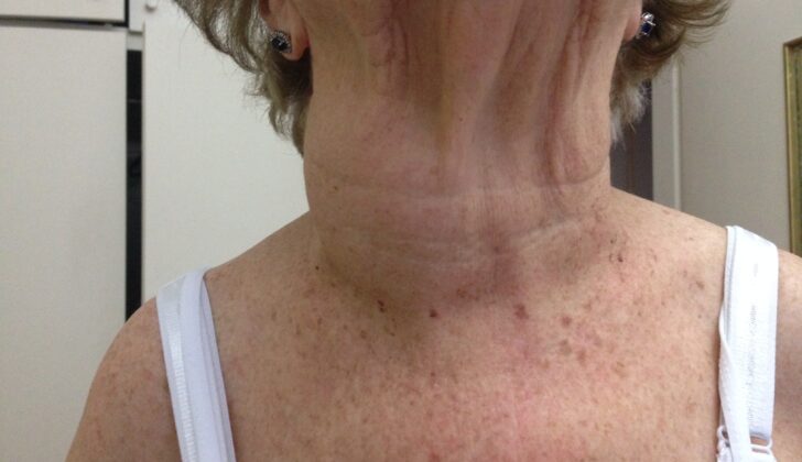 Right thyroid nodule, multinodular goiter