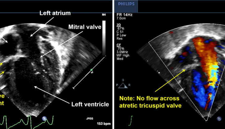 Echocardiography of a Patient With Tricuspid Atresia. Illustrated anatomy includes right atrium, left atrium, atretic tricuspid valve, mitral valve, and left ventricle.