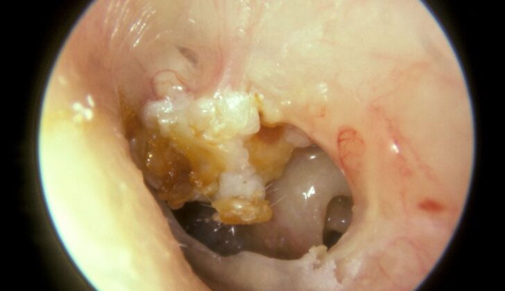 Cholesteatoma in the Left Tympanic Membrane. A large mass of white keratin debris is visible in the left upper quadrant of the left tympanic membrane, indicating a cholesteatoma. The majority of the tympanic membrane is missing due to perforation. In the lower right quadrant, the round window niche on the medial wall of the middle ear is visible.