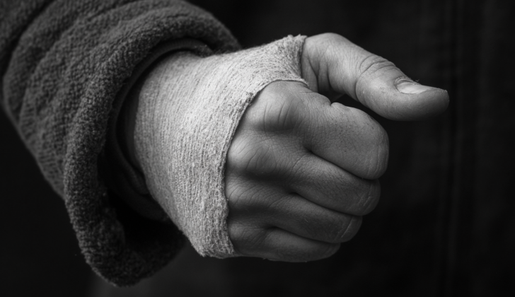 Person with splint on hand and thumb