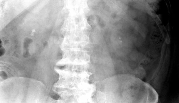 Renal Stones on KUB Radiography. This x-ray shows renal calculi in the right and left kidneys.